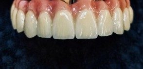 Implantátumokra készült körkörös felső híd élethű ínyporcelánnal a laborban