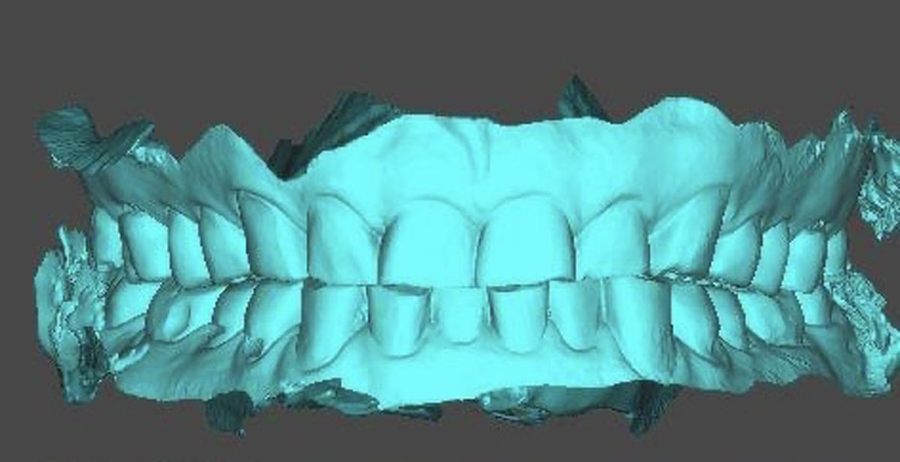 Digitális 3D lenyomat szkennelt fogsorról