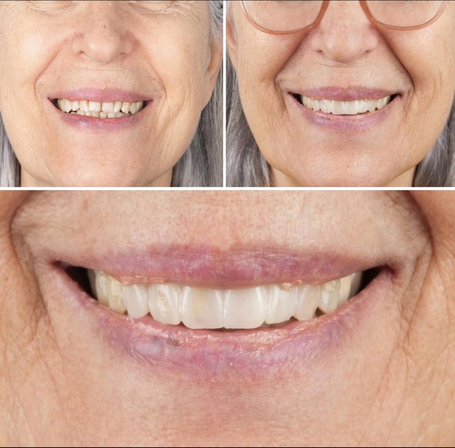 Smile Design mosolytervezés — a páciens mosolya a tervezés előtt és a kész munkával